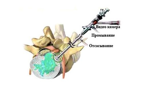 Гидропластика грыжи позвоночника