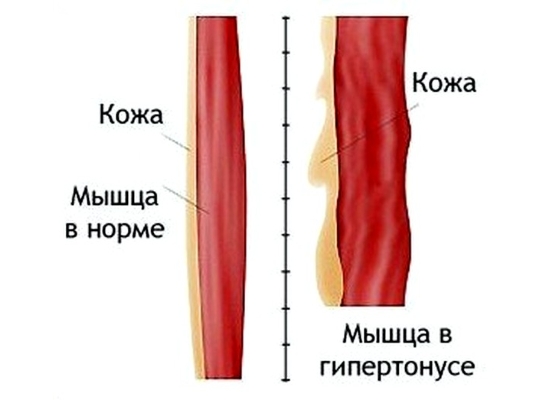 Гипертонус мышц