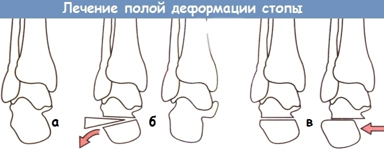 Хирургия конской стопы