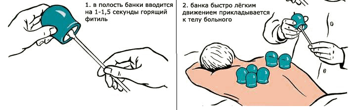 Инструкция по установке вакуумных банок с огнём