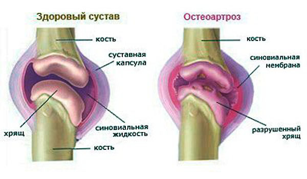 Изменения при остеоартрозе