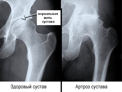 Изменения при коксартрозе на рентген снимке