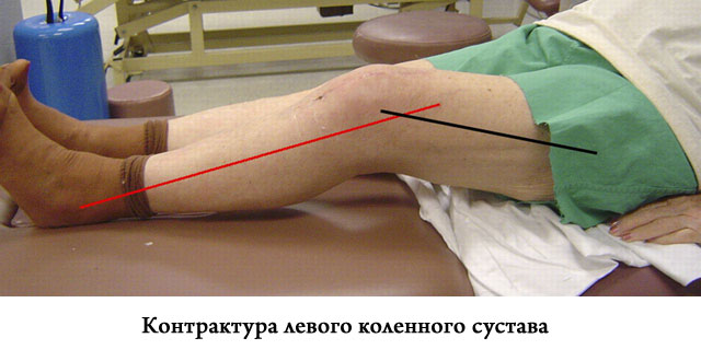 Контрактура коленного сустава
