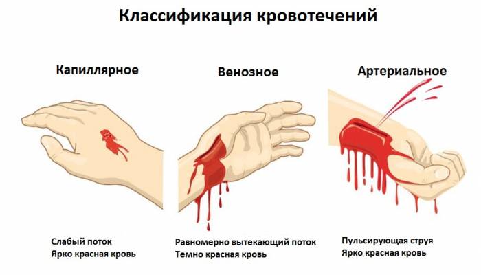 Виды кровотечений