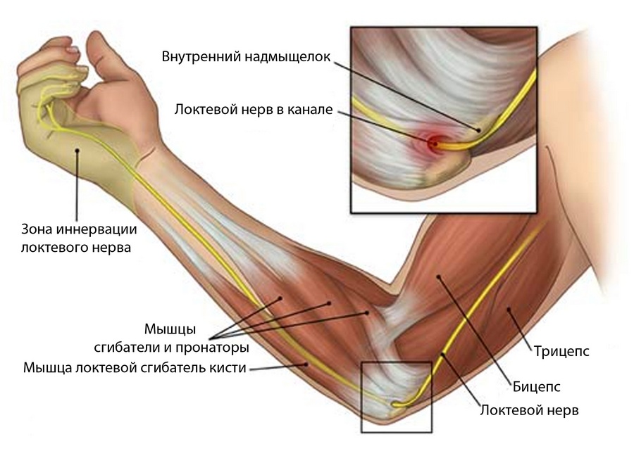 Кубитальный туннельный синдром локтевого нерва