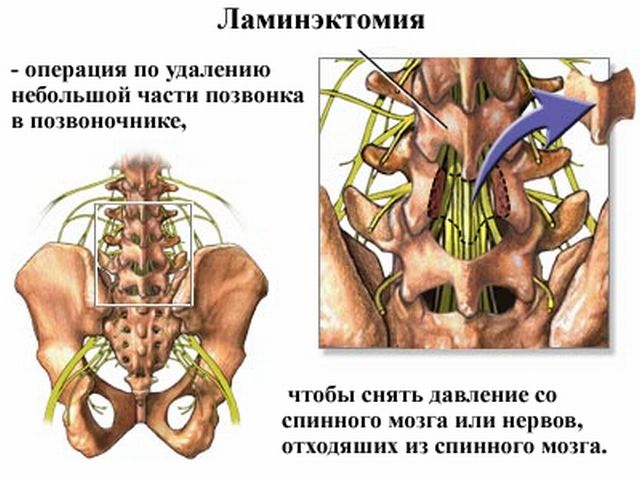 Ламинэктомия при грыже позвоночника