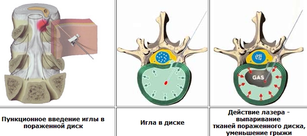Лазерная вапоризация грыжи позвоночника