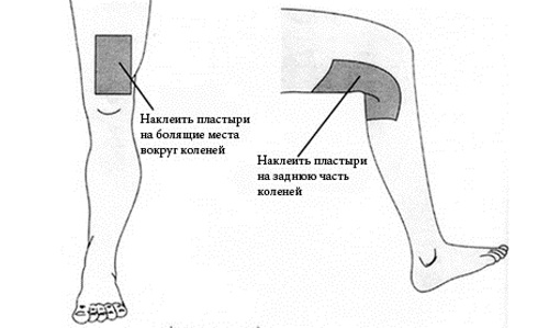 Наложение горчичников на коленный сустав