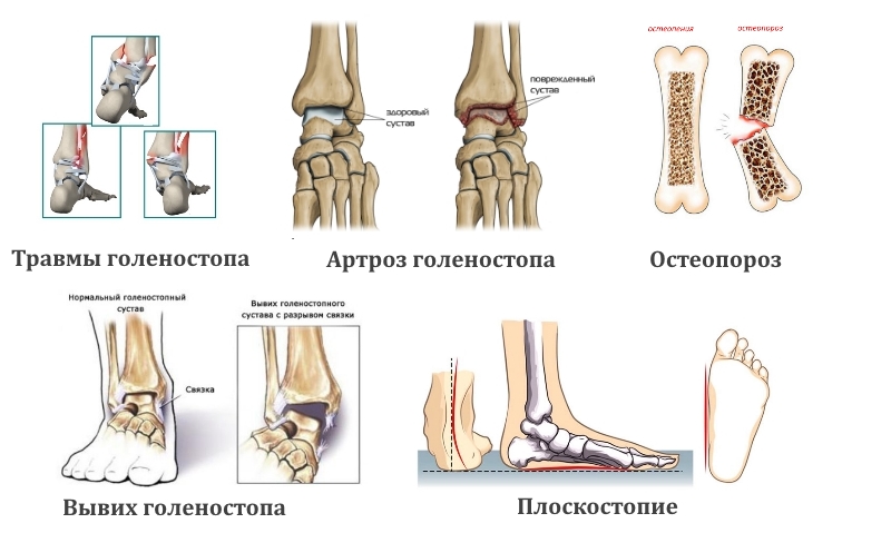 Назначение рентгена голеностопа