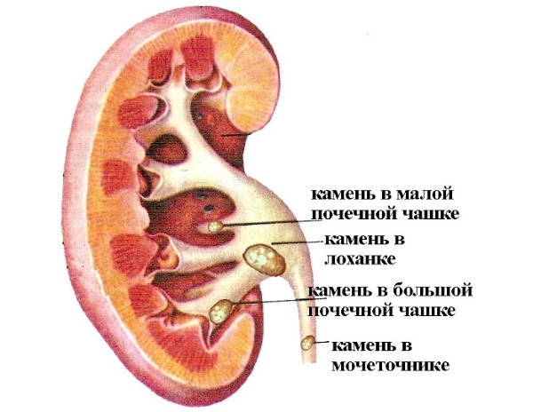 Образование камней в почках