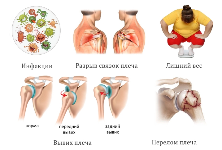 Общие причины боли в плече