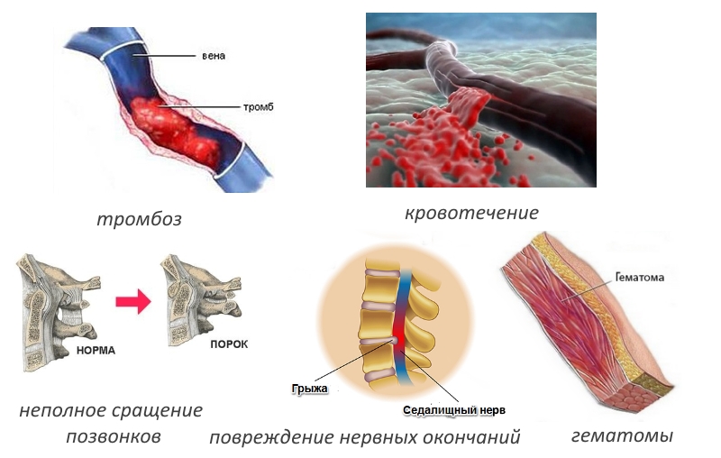 Частые осложнения после спондилодеза