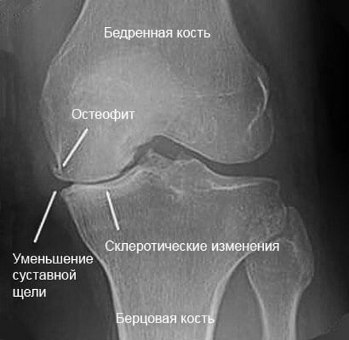 Остеофиты колена на рентгене