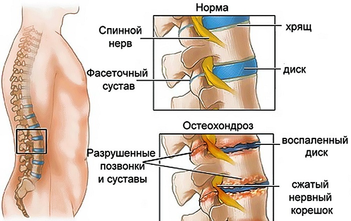 Остеохондроз позвоночника