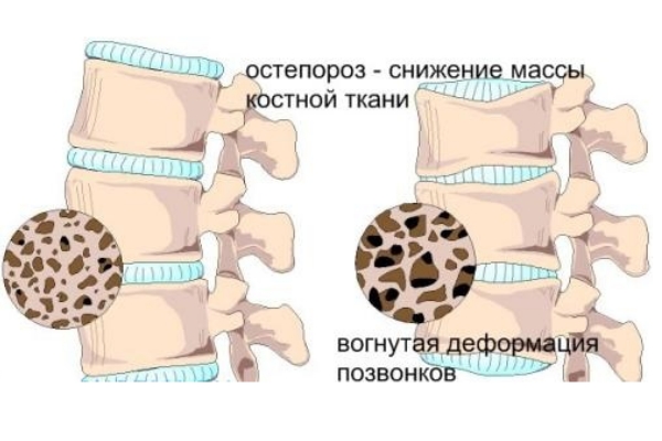 Остеопороз