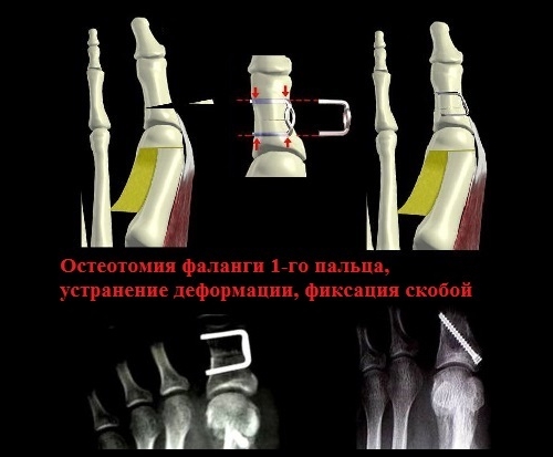 Остеотомия пальца стопы винтом