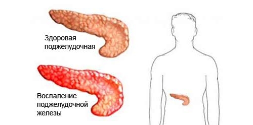 Панкреатит