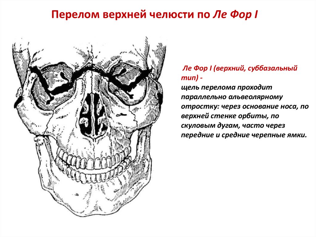 Перелом верхней челюсти по типу Ле Фор 1
