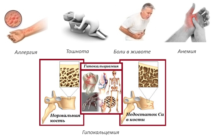 Побочные эффекты Кальцитрина