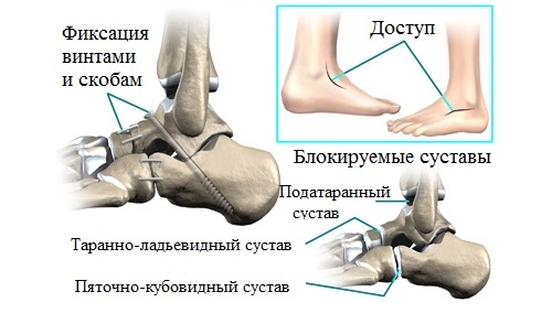 Подтаранный артроэрез