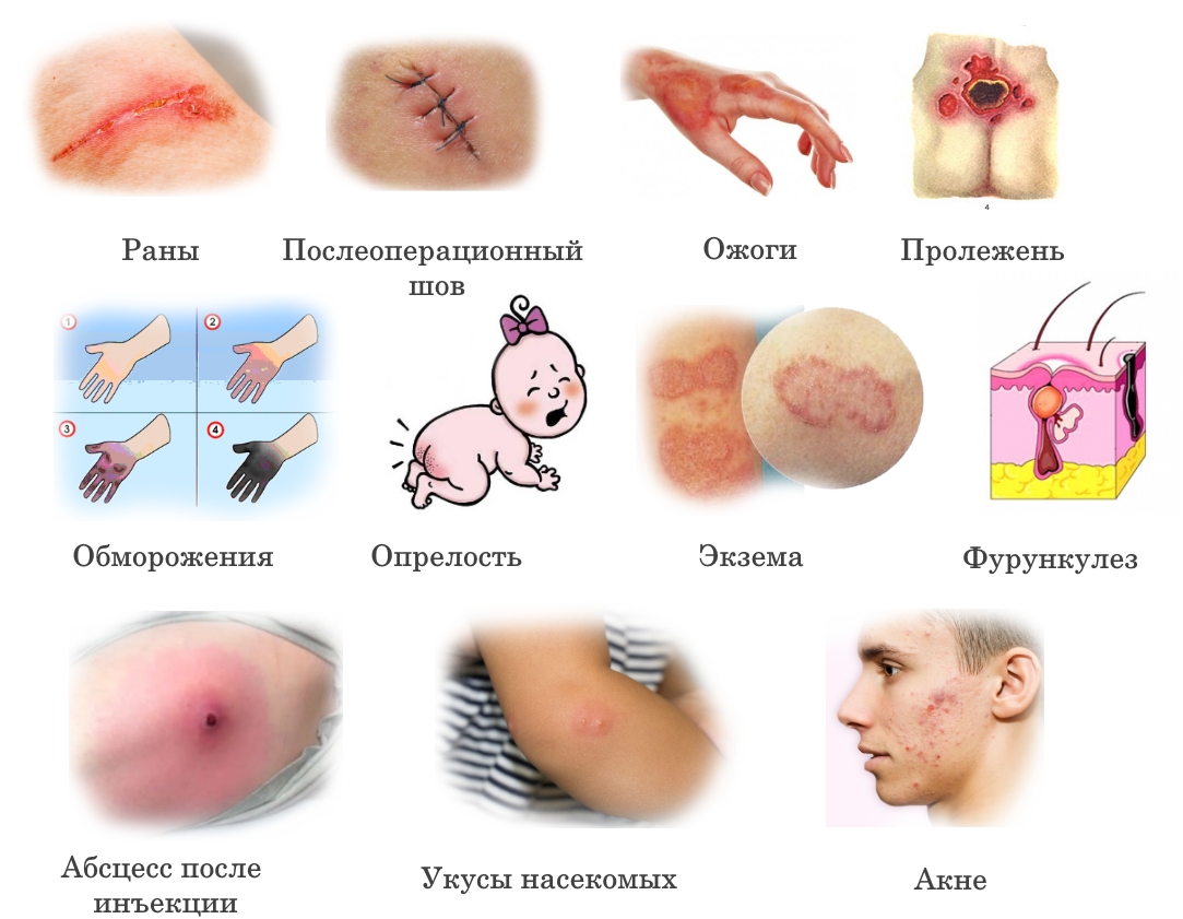 Показания для Левомеколя
