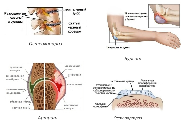 Показания для Диацереина