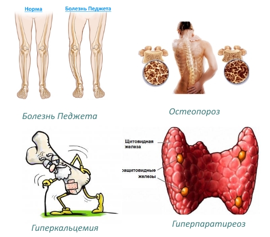 Показания для Остеовера