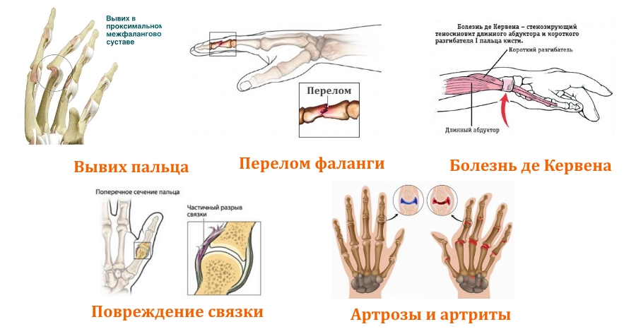 Показания для ношения ортеза на палец