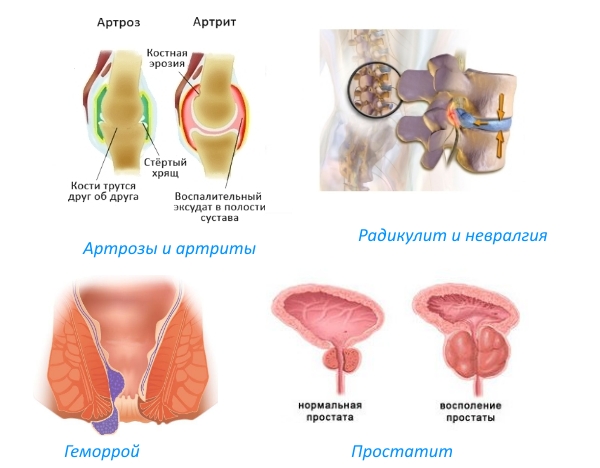 Показания для применения свечей Кетонала
