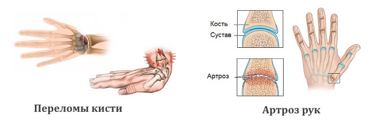 Показания для рентгена кисти