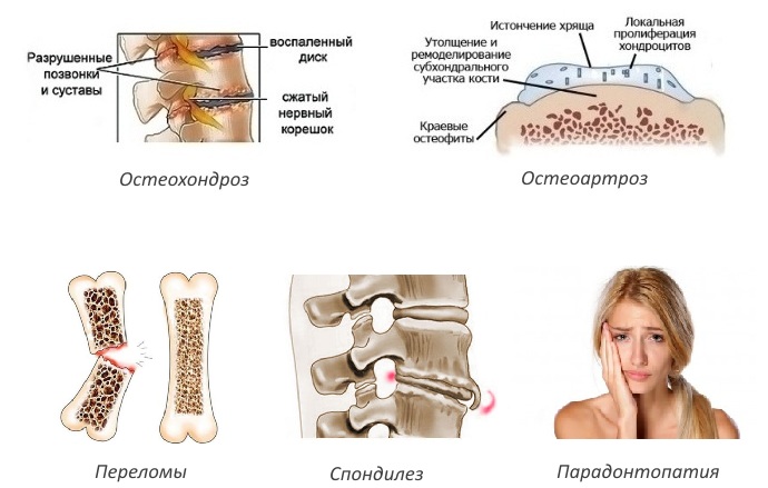 Показания для уколов Хондроитина