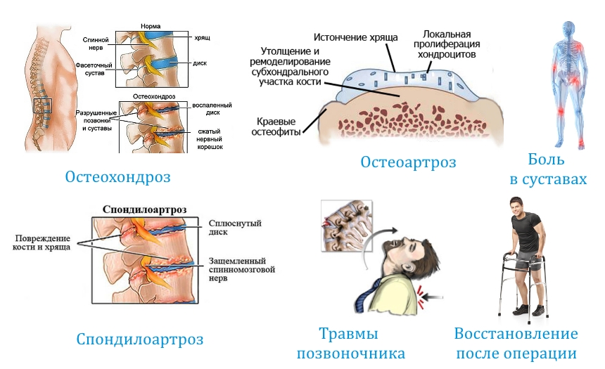 Показания к Артифлексу