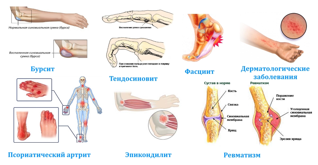 Показания для Флостерона