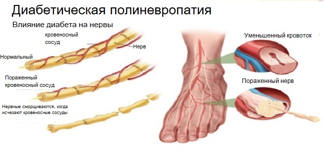 Полиневропатия