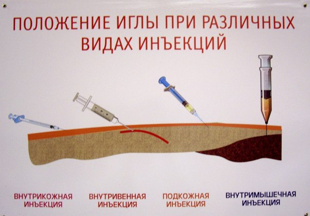 Положение иглы при различных видах иньекции