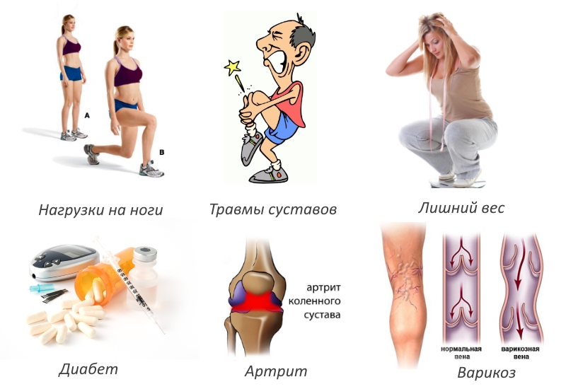 Частые причины гонартроза