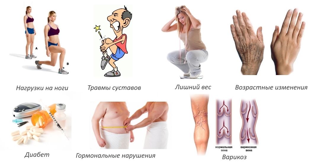 Причины гонартроза