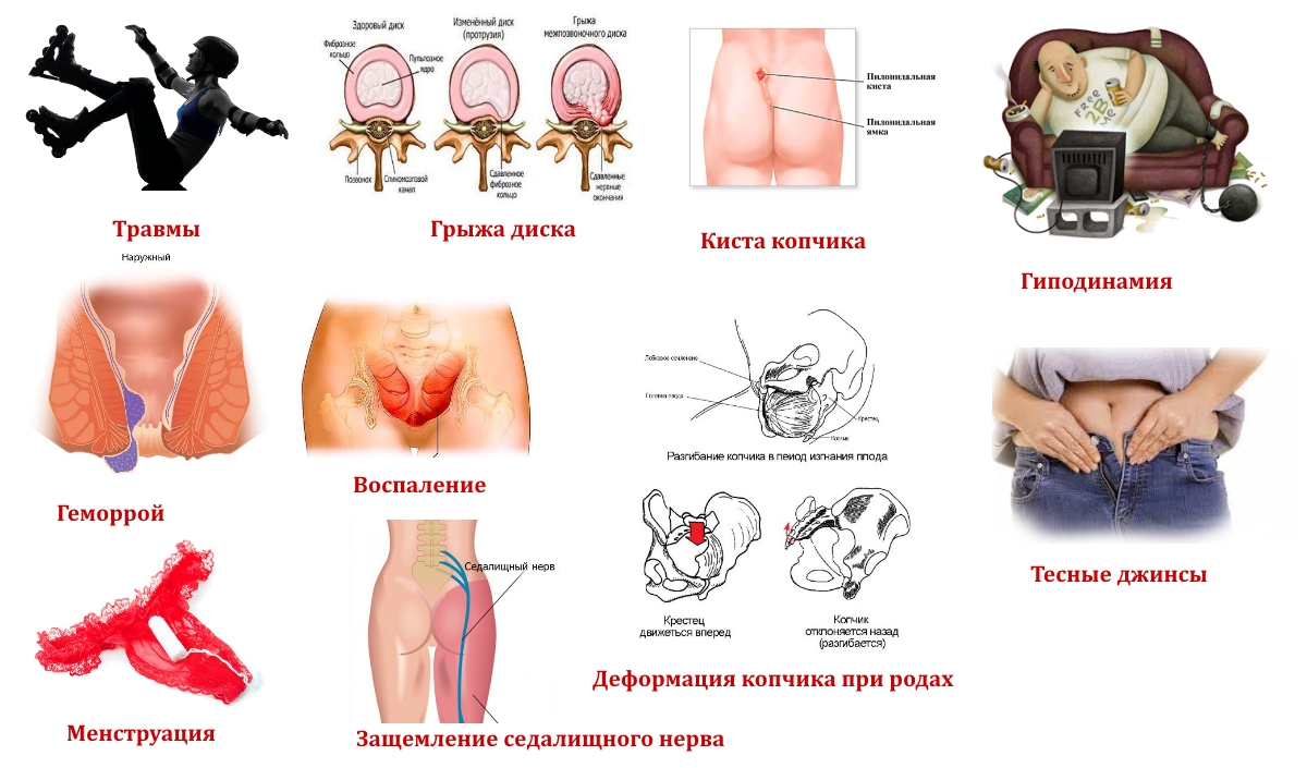 Причины боли в копчике