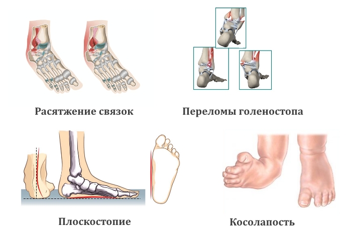 Причины боли в голеностопном суставе