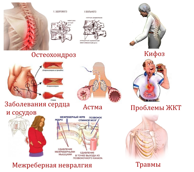 Причины боли в грудном отделе позвоночника
