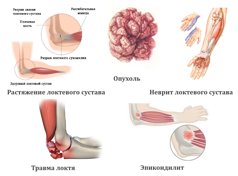 Причины боли в локте