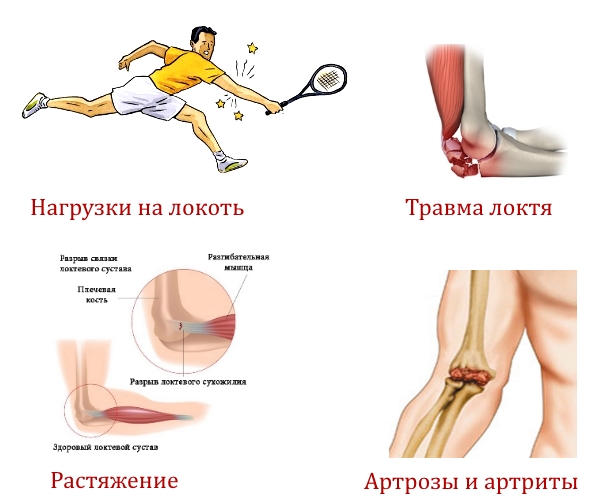 Частые причины боли в локте