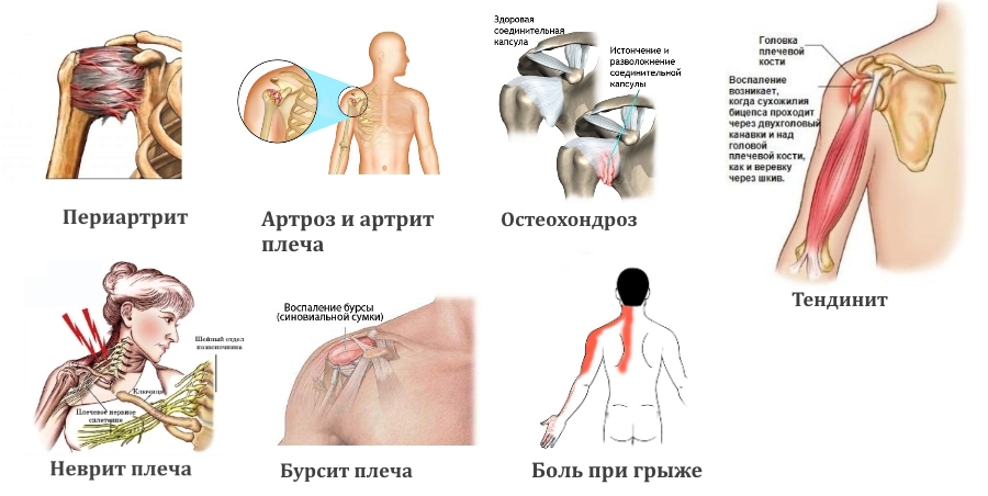 Причины боли в области плеча