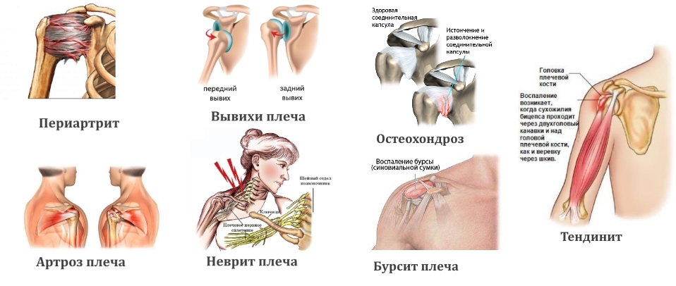 Частые причины боли в плече