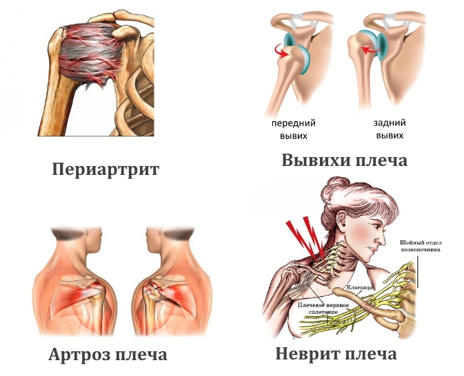 Заболевания плечевого сустава