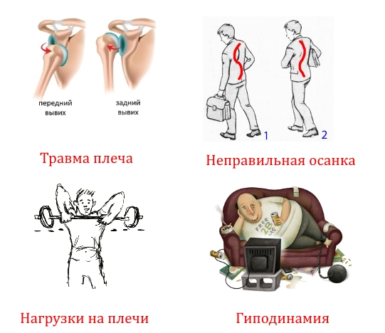Частые причины боли в плече