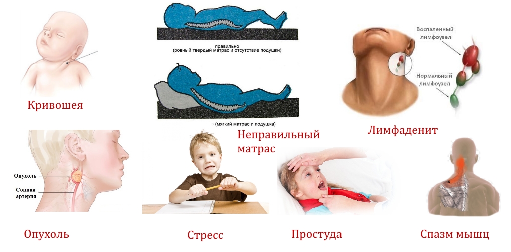 Причины боли в шее у детей