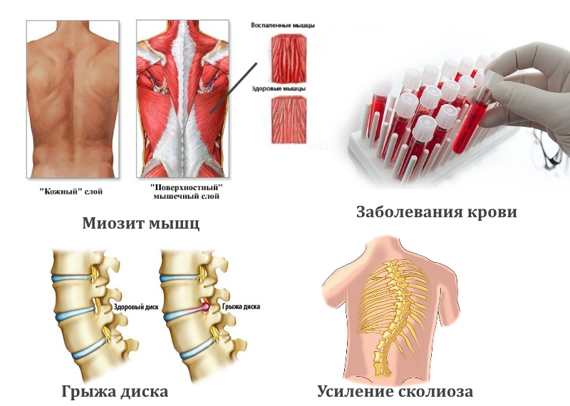 Заболевания — причины боли в спине
