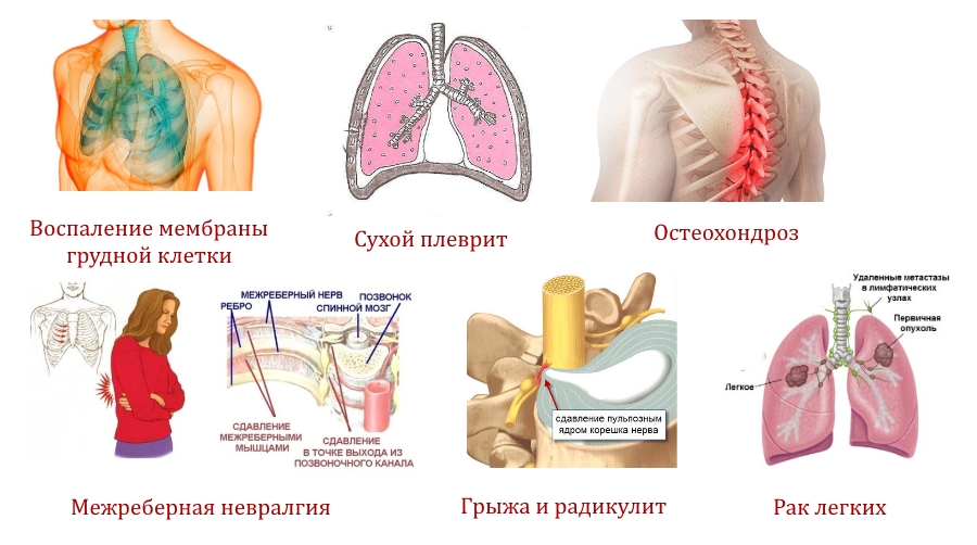 Причины боли в спине в области грудной клетки