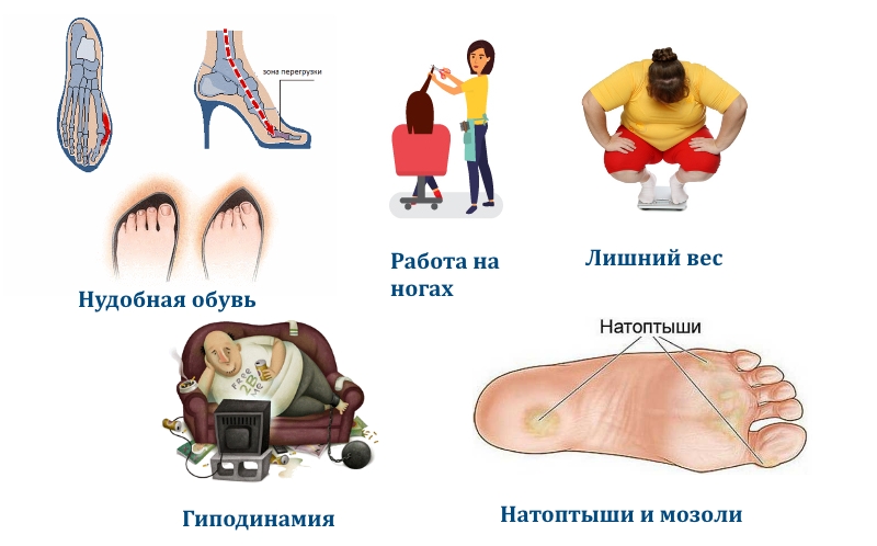 Частые причины боли в ступнях
